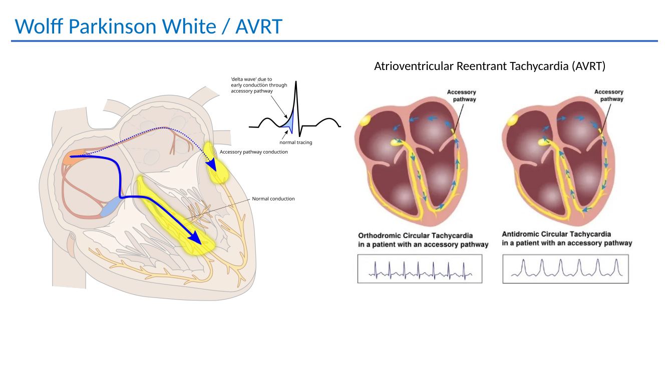 WPW and AVRT mechanism