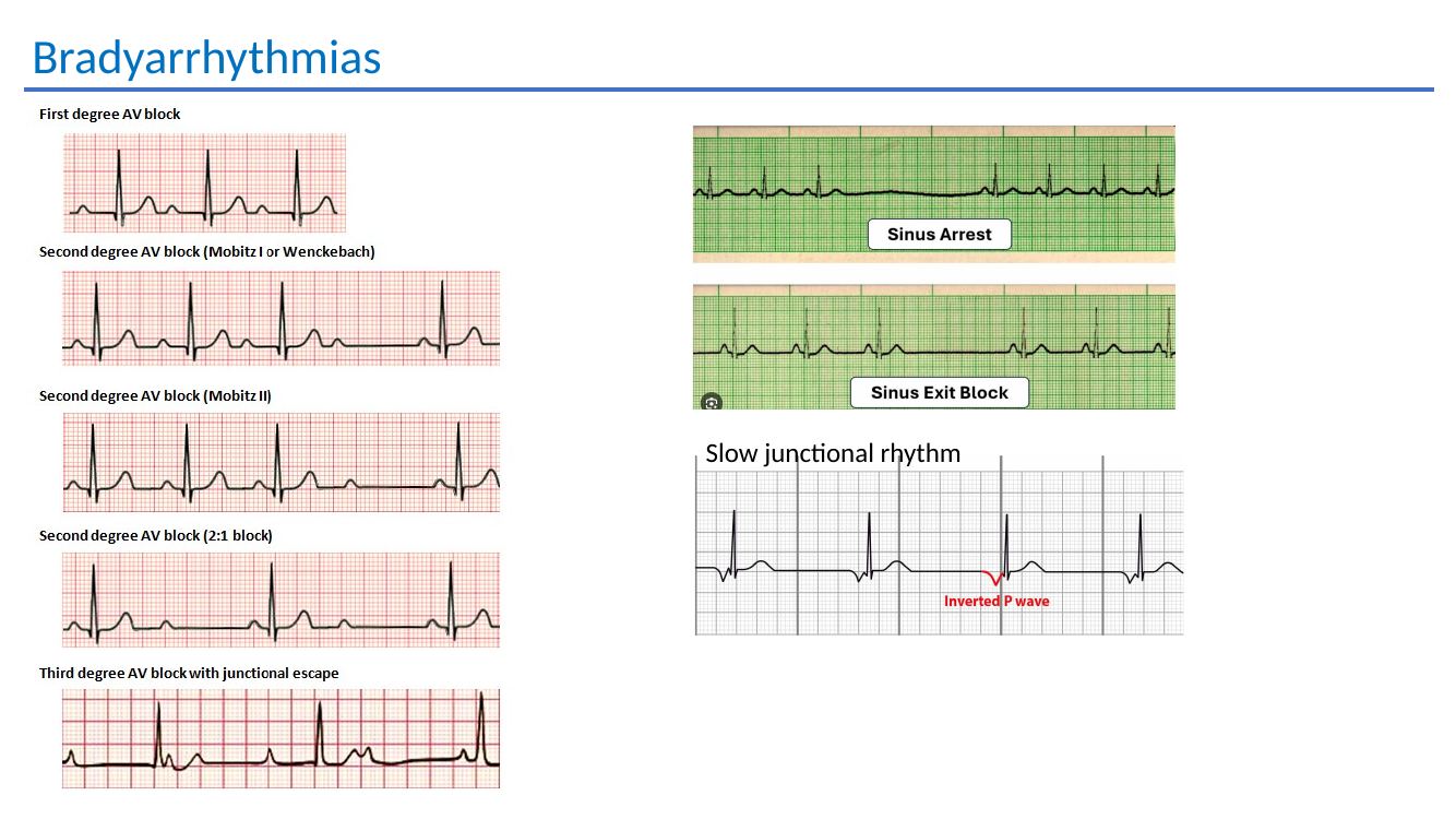 Bradyarrhythmia ECG teaching slide