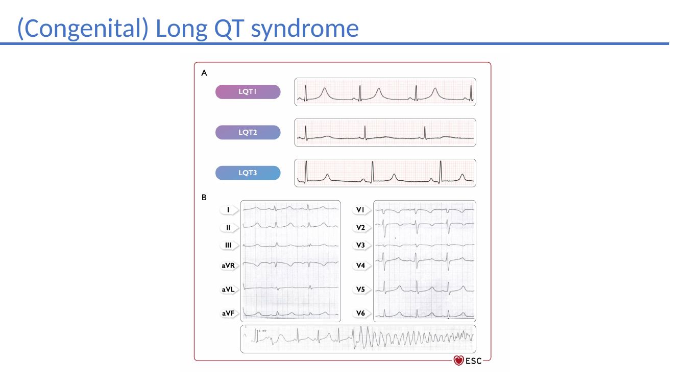 Congenital long QT syndrome