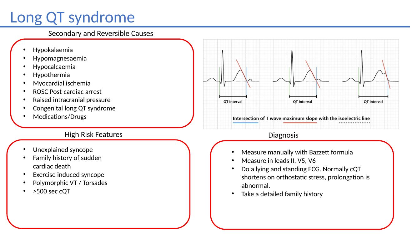 Long QT syndrome ECG slide