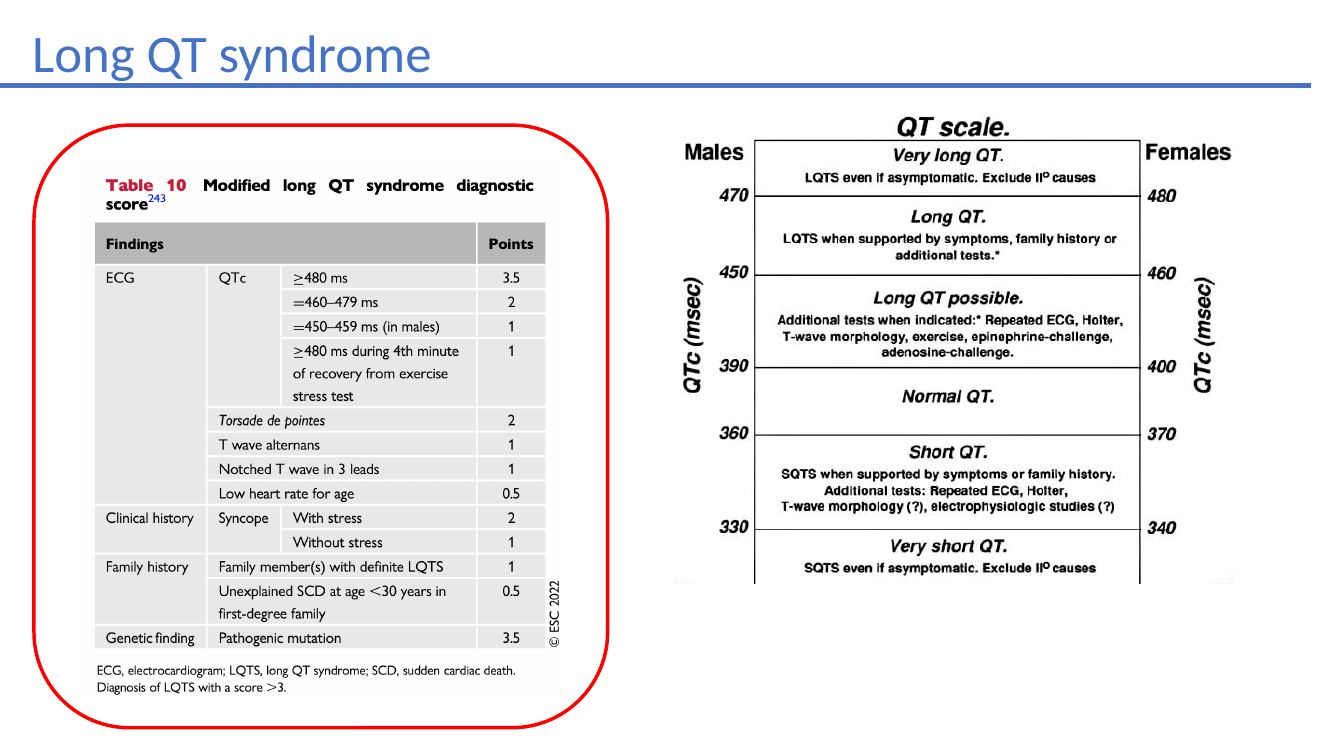 Long QT syndrome ECG teaching